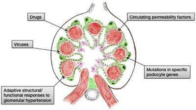 Disease Recurrence—The Sword of Damocles in Kidney Transplantation for Primary Focal Segmental Glomerulosclerosis